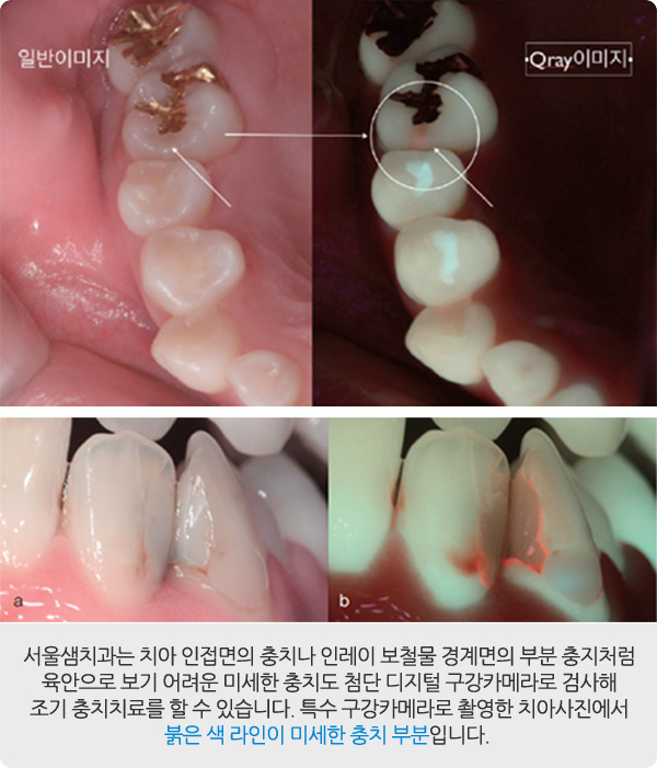 충치치료
