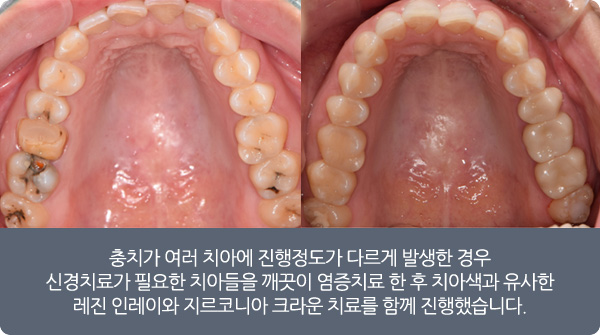 충치치료