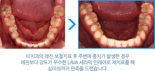 충치치료