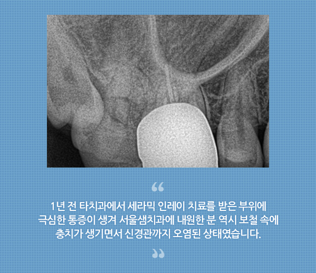 신경치료/재치료