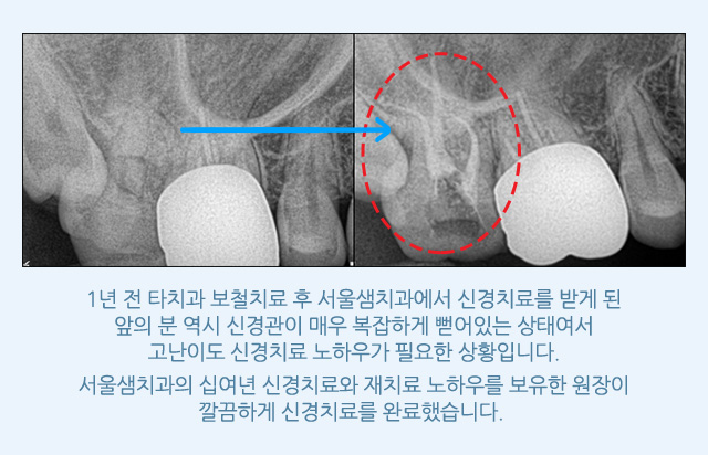 신경치료/재치료