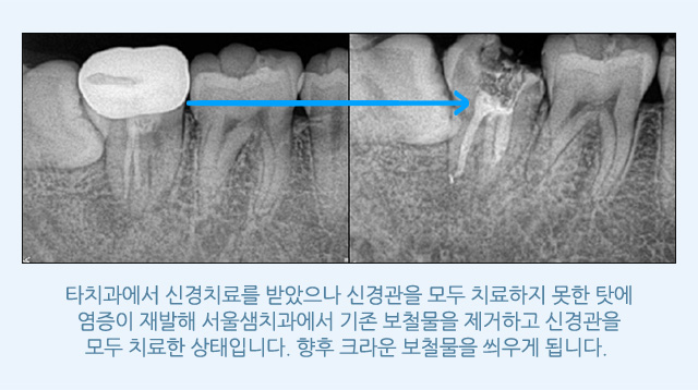 신경치료/재치료