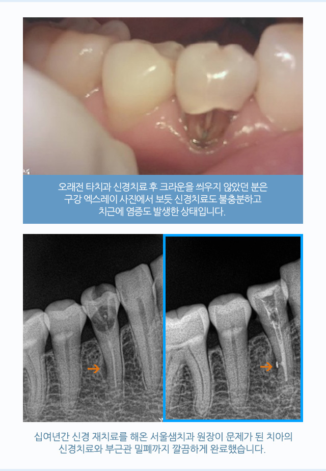 신경치료/재치료