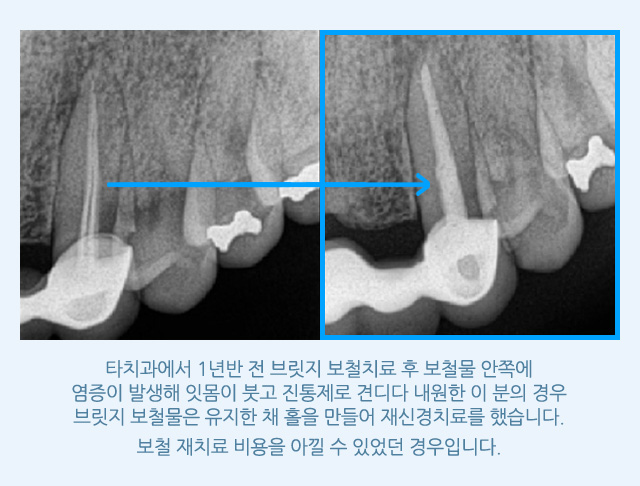 신경치료/재치료