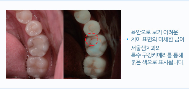 금 간 치아