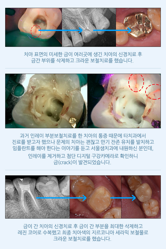 금 간 치아