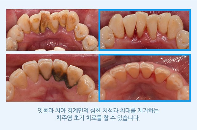 치주치료